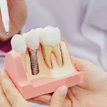 Types of Dental Implants & What’s Best for You