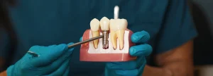 Dental Implants